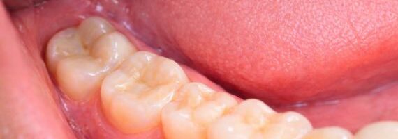 teeth-filling-after-in-dubai