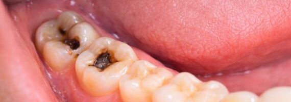 teeth-filling-before-in-dubai