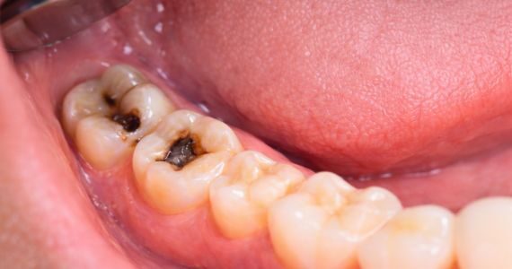 teeth-filling-before-in-dubai