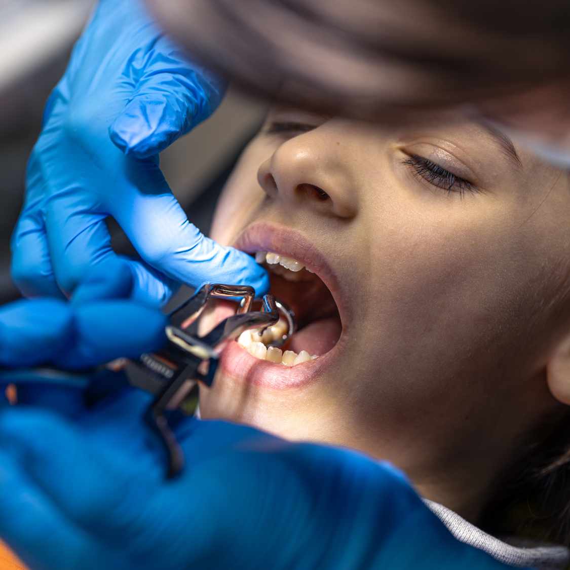 tooth-extraction-in-dubai