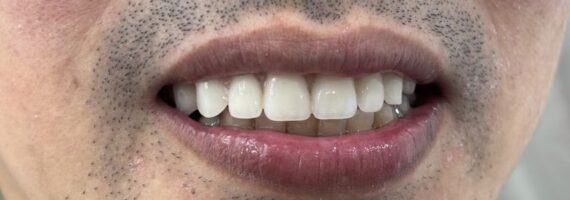 top-denture-treatment-dubai-after