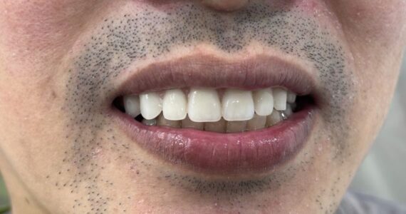 top-denture-treatment-dubai-after