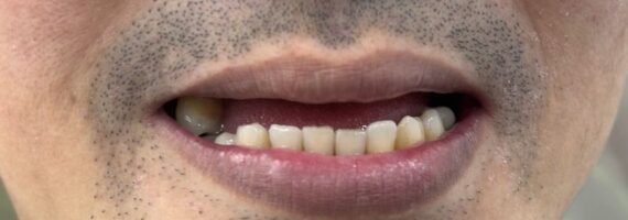 top-denture-treatment-dubai-before