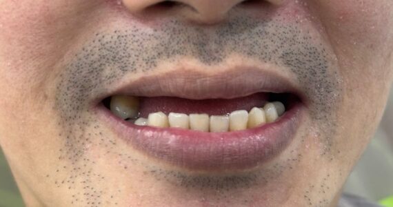 top-denture-treatment-dubai-before