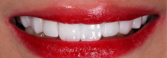 vaneer-treatment-rigga-after