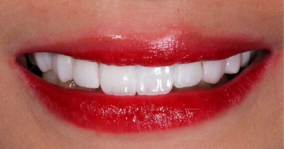 vaneer-treatment-rigga-after