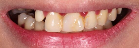 vaneer-treatment-rigga-before