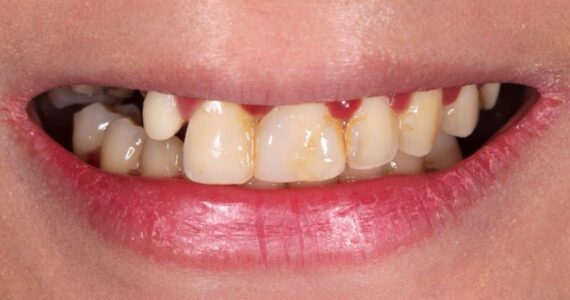 vaneer-treatment-rigga-before